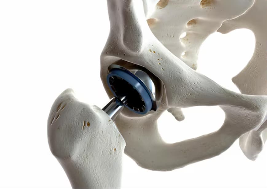 rehabilitacion protesis de cadera
